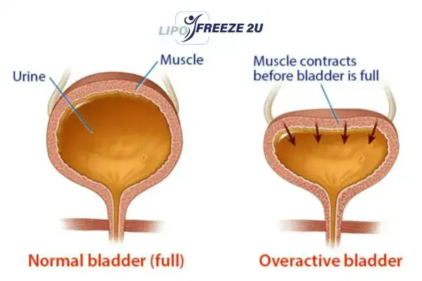 diagram of overactive bladder treatment Worksop