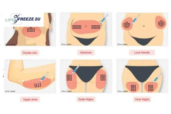 Benefits of Choosing Aqualyx for Fat Reduction Worksop