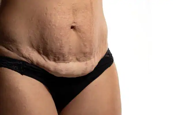 loose skin after weight loss injections Worksop