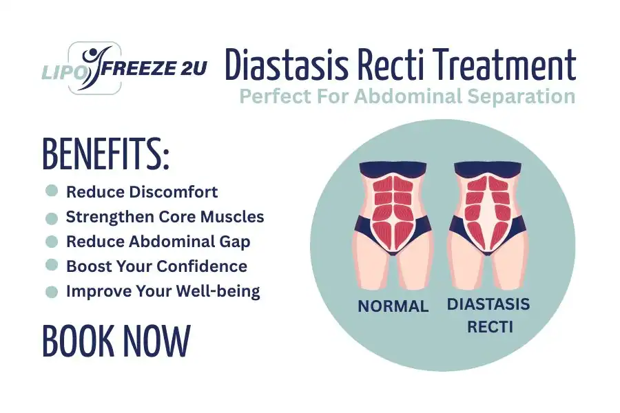 How Long Will It Take to See Improvements in Diastasis Recti Worksop