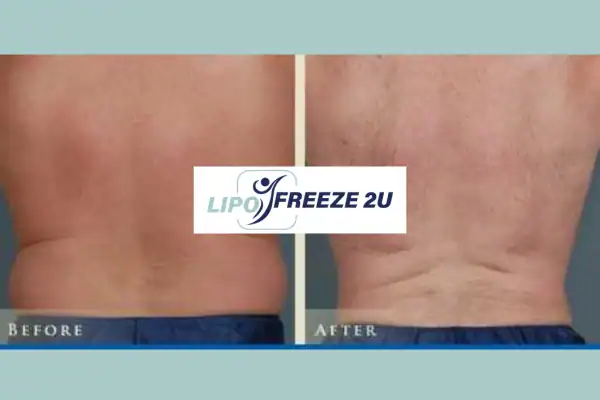 Fat Freezing Cryolipolysis Before After Results