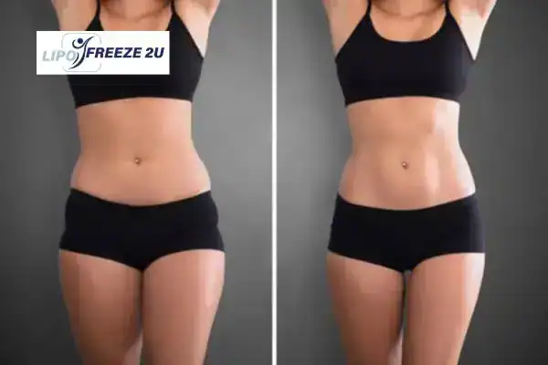 How Can LIPO FREEZE 2U Support Your Post-Pregnancy Body Recovery Worksop?