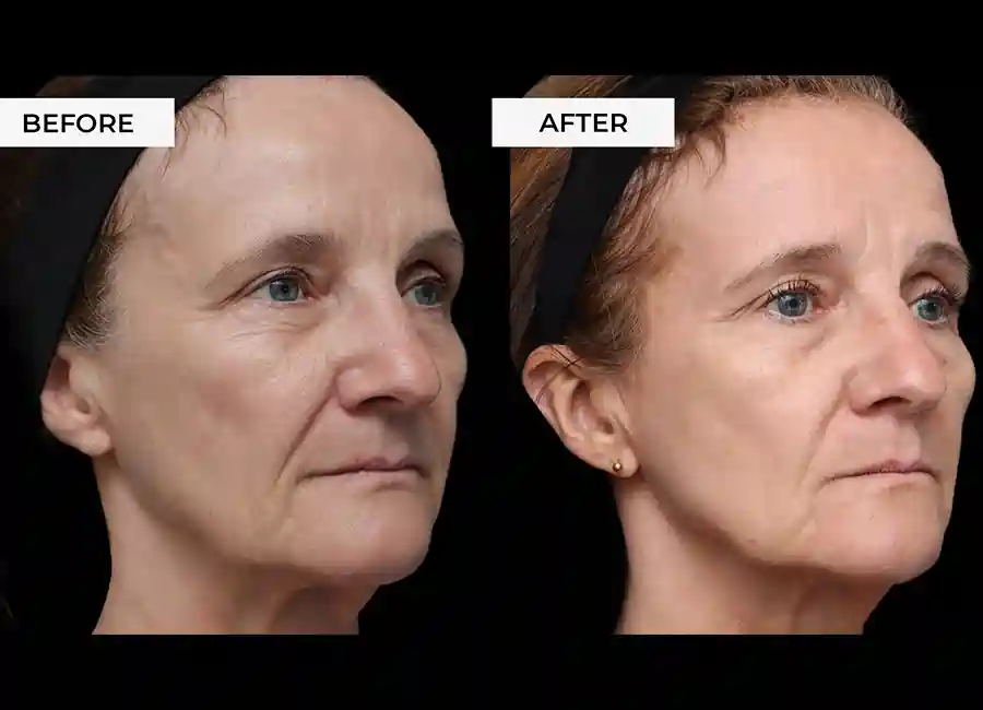 How Many RF Microneedling Sessions Will You Need to See a Difference Worksop?