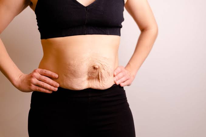 Is Surgery Really the Only Way to Repair Diastasis Recti Worksop?