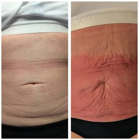 How Does RF Microneedling Improve Crepey, Thin and Uneven Skin Texture Worksop?