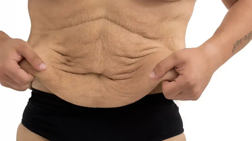 Why Does Weight Loss Medication Leave Some People With Loose or Sagging Skin Worksop?